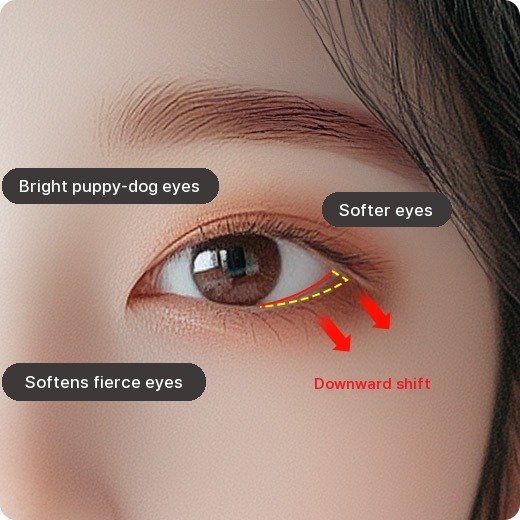 Lower Canthoplasty: Bright puppy-dog eyes, Softer eyes, Softens fierce eyes, Downward shift