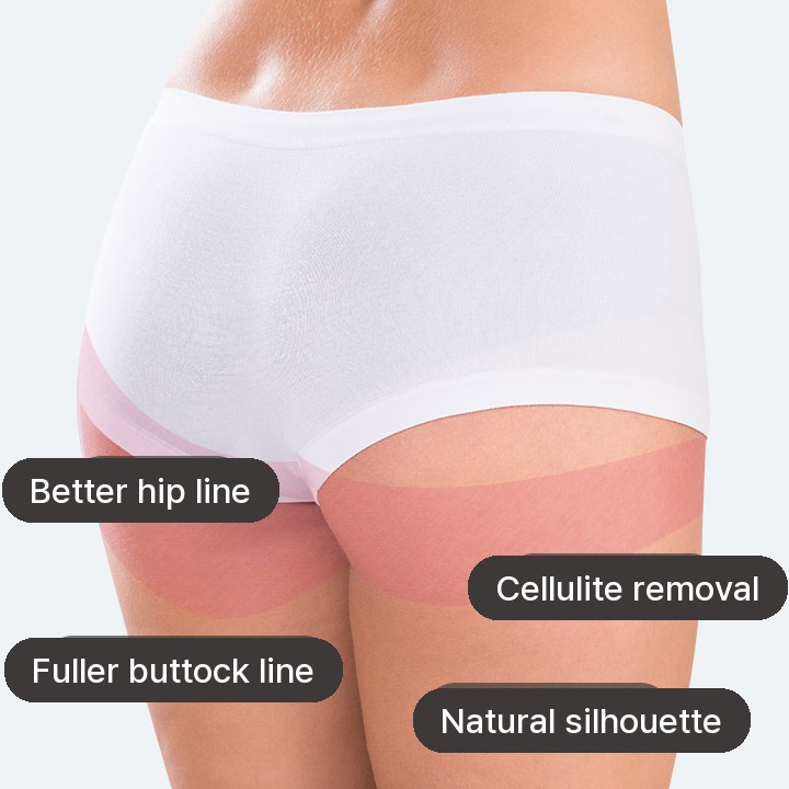 Hip Liposuction: Better hip line, Cellulite removal, Fuller buttock line, Natural silhouette